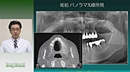 口腔外科医と学ぶ「フィクスチャー埋入術」〜どうする?ソケットリフト法による上顎インプラント治療〜