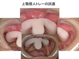 鶴見大学先制医療研究センター 医療技術トレーニングシリーズ 高精度全部床義歯の製作 〜ピエゾグラフィ