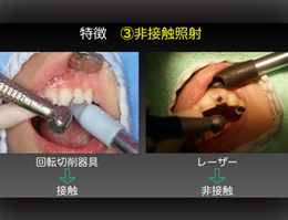 ステップアップ!歯科外科手術　応用編2　「レーザー治療(光歯科治療)最前線」