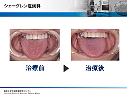 ドライマウス(口腔乾燥症)の原因と対処法　〜診断と治療の実際〜