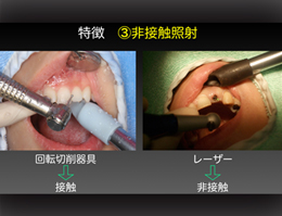 ステップアップ!歯科外科手術　応用編2　「レーザー治療(光歯科治療)最前線」